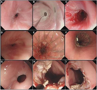 Endoscopic Treatment for Pediatric Esophageal Stenosis Induced by Chemical Burn, Congenitally, or After Surgical Repair of Esophageal Atresia